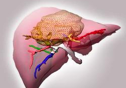 ESMO 2016：Regorafenib显著提高肝细胞癌患者生存期（附<font color="red">梅斯</font>医学评论）