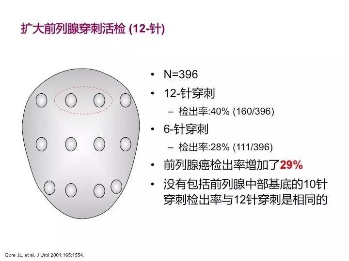 前列腺穿刺12点示意图图片