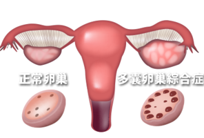 JCEM：双侧肾上腺增生可能是PCOS女性雄激素增多的原因