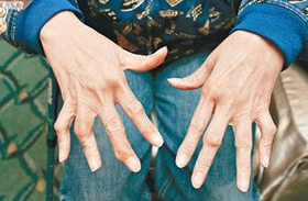 Arthritis Rheum：RA患者暴露于TNFi，不会增加<font color="red">缺血性</font>卒中风险