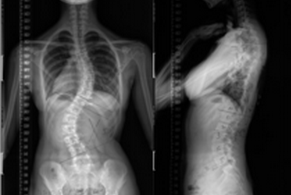 J Bone Joint Surg：一些主要的脊柱侧凸手术或许是可以避免的