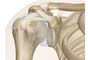 AOS 2016：术前病情视为前肩关节不稳定基本功能恢复的的关键