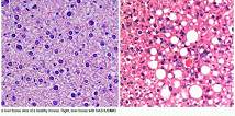 Cancer Cell：揭示触发<font color="red">非</font>酒精性<font color="red">脂肪性肝炎</font>和肝癌产生机制