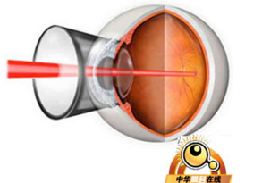 Ophthalmic Surg Lasers Imaging Retina：雷珠单抗治疗DME：<font color="red">0.5</font> mg vs. 1 mg