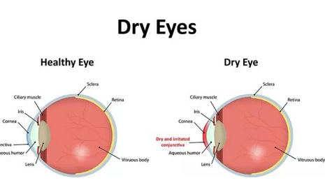美国FDA批准首个干眼症新药