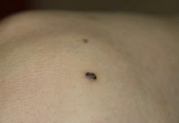 JAMA Dermatol：黑色素瘤筛查时，肛周痣也不能放过