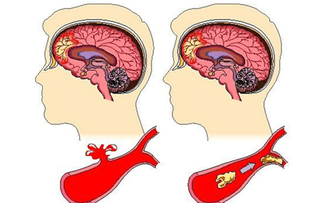 Neurology：围产期脑卒中后，后代远期<font color="red">癫痫</font>发作的<font color="red">风险</font>研究