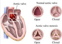 Am J Cardiol： 经导管主动脉瓣置换的死亡率没有性别差异