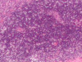 JAP：脂肪细胞或在抗乳腺癌<font color="red">中</font>起<font color="red">关键作用</font>