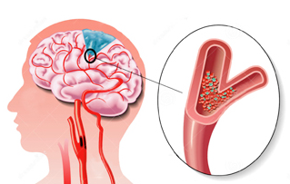 Lancet neurol：院前溶栓的移动卒中<font color="red">治疗</font>单元优于传统<font color="red">治疗</font>吗？