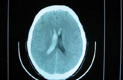 Stroke：静脉溶栓后远隔部位脑实质出血的危险因素研究
