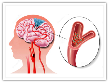 2015中国缺血性<font color="red">脑卒中</font>血管内治疗指导规范发布