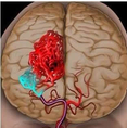 我国科学家发现<font color="red">尿激酶</font>对治疗脑出血有特殊作用