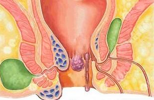 Lancet：同种异体脂肪间充质干细胞填充治疗克罗恩病复杂肛瘘安全有效