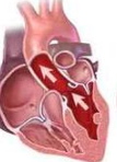扩张型心肌病患者左心室逆重构