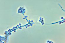 2016IDSA临床实践指南——球孢子菌病的治疗发布