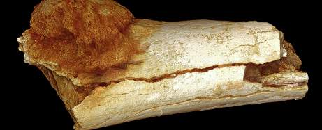 <font color="red">考古学家</font>发现一百七十万年前的古人也患癌症