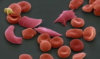 NEJM：镰状细胞特征可显著增加运动性<font color="red">横纹肌</font>溶解症而非死亡的发生风险但