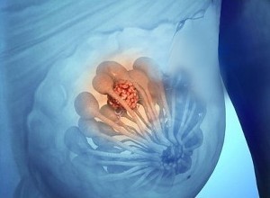 Sci Rep：新研究证实女性乳腺组织中存在菌群 可能与乳腺癌发生有关