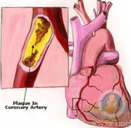 【综述】主动脉内球囊反搏在急性心肌梗死患者中的应用进展