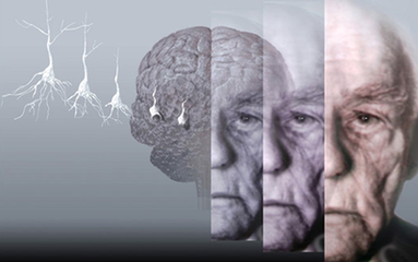 J Alzheimers Dis：老年人较低的BMI或可预测阿尔茨海默氏病发生