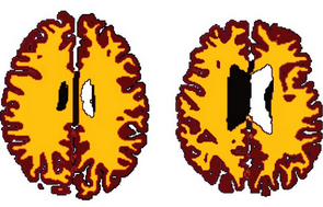 新研究表明：<font color="red">肥胖者</font>的脑部年龄比正常人老十岁！