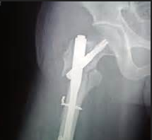 2016青壮年股骨颈骨折的显微外科治疗专家共识发布