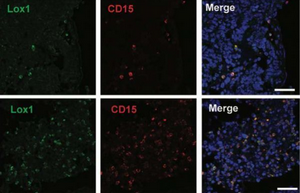 Sci Immunol：科学家鉴别出骨髓衍生抑制细胞的特殊标志物