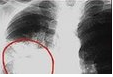 2016中国肺癌重要指南共识回顾