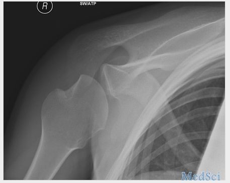 BMJ：肩关节Hill-Sachs损伤所致的反复性关节脱位