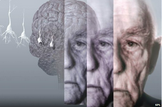 JAMA Neurol：卒中史增加迟发性阿尔茨海默病风险
