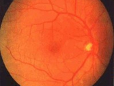 Retina：黄斑裂孔手术哪种染色更优？