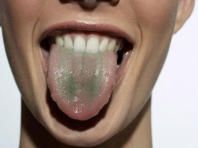 印度医生首次将3D打印技术用于舌癌手术