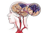 Stroke：缺血性卒中或短暂性脑缺血发作患者发生脑微梗死危险因素有哪些？