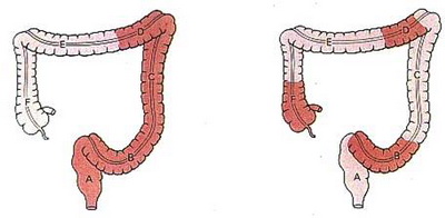 Gastroenterology：溃疡性<font color="red">结肠炎</font>相关结直肠癌监测该用随机活检还是针对性活检？