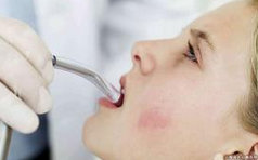 Cancer：口腔卫生会影响HPV相关头颈部鳞状细胞癌的患病风险吗？