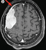 <font color="red">2016</font>EANO指南——脑膜瘤的诊断和治疗发布