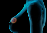 Nature子刊：乳腺癌还与细菌有关？