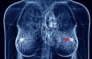 乳腺癌21基因检测的背景与应用