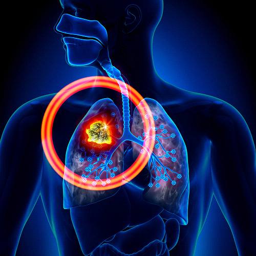 ASTRO 2016：立体定向放射治疗增加早期非小细胞肺癌患者的生存率
