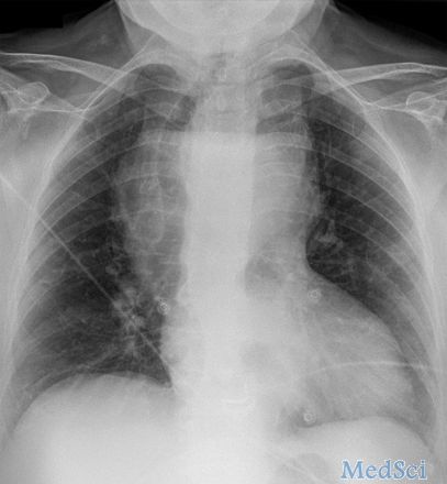 BMJ：巨大胸甲状腺肿所致的呼吸困难