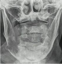 BMJ：罕见病例——肝细胞癌转移至下颌骨