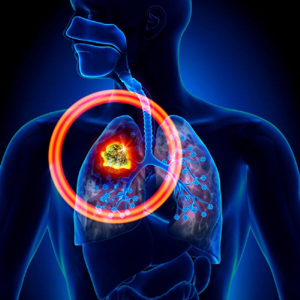 ASTRO 2016：非小细胞肺癌：加速超分割放射治疗 vs 常规放疗