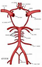 Stroke：血管迂曲与颈动脉夹层相关