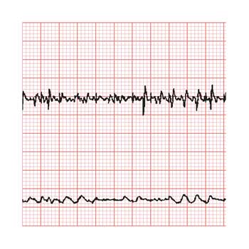 <font color="red">JAMA</font>：院内心脏骤停使用低温治疗或降低患者的存活率