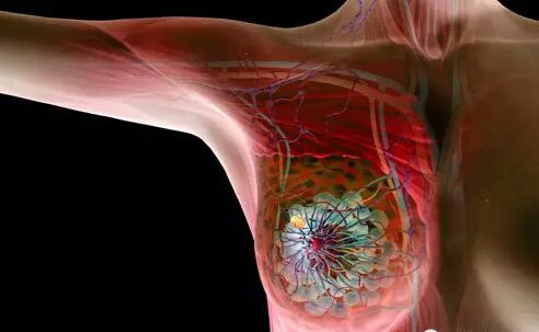 Oncogene：靶向受体蛋白延缓乳腺癌转移