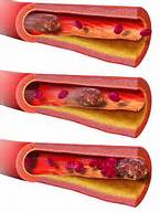 JACC：氨基<font color="red">甲</font>酰化低密度脂蛋白促进血栓形成