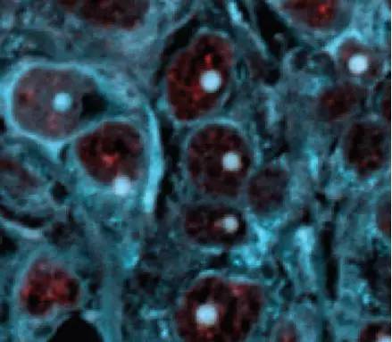 Dev Cell：癌细胞也会患阿尔兹海默氏症！或点亮癌症新疗法