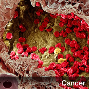 2016NCCN临床实践指南——<font color="red">非</font>霍奇金淋巴瘤：<font color="red">弥漫性</font>大B细胞淋巴瘤-证据块（2016.V2）发布