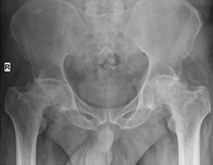 BMJ：年轻人腹股沟持续疼痛，警惕股骨头坏死！——案例报道